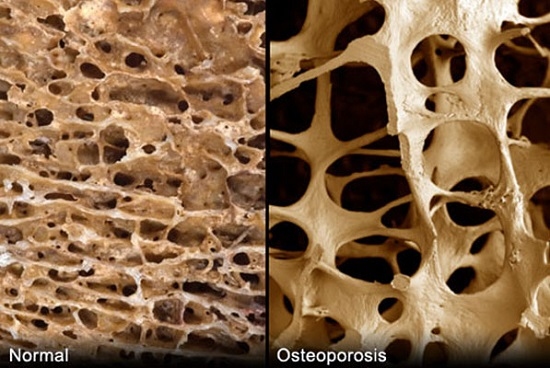 Šodien Pasaules osteoporozes diena