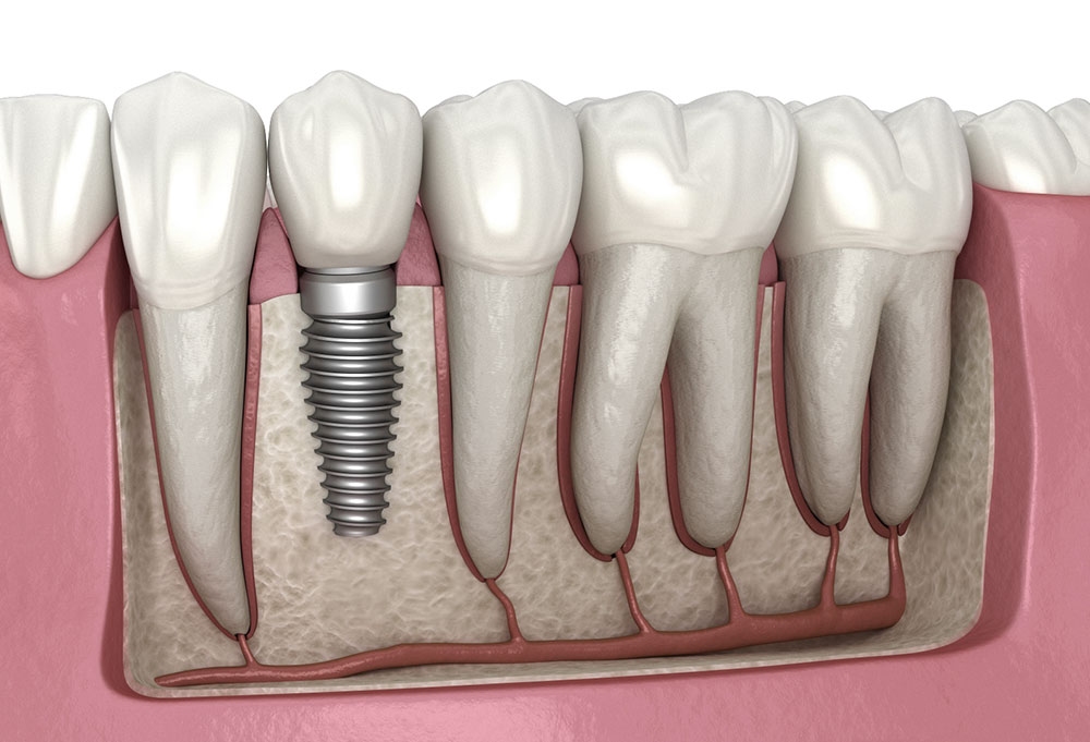 Zobu implanti – iespēja atgriezt skaistu smaidu